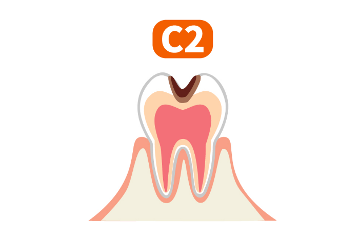 C2（象牙質の侵食）